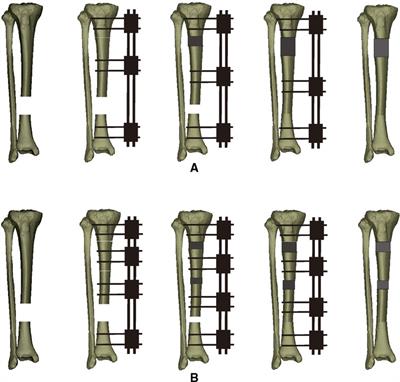 Bone Defects in Tibia Managed by the Bifocal vs. Trifocal Bone Transport Technique: A Retrospective Comparative Study